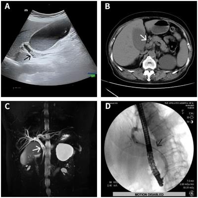 A missed case of intraductal oncocytic papillary neoplasm associated with missed stones in extrahepatic bile duct: a case report